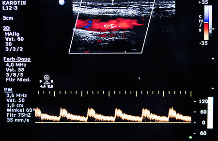 Gefäßultraschall