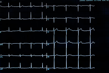 EKG