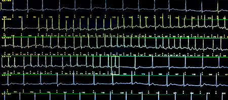Langzeit EKG