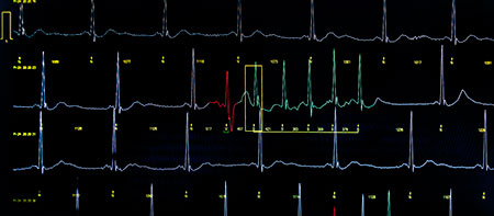 Langzeit EKG Auffälligkeiten